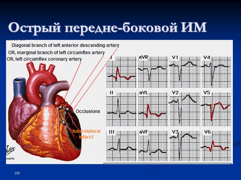 103 Острый передне-боковой ИМ
